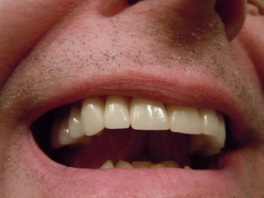 The Impact Illegal Drugs Can Have on Your Teeth